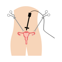 endometriozis-laparoskopi